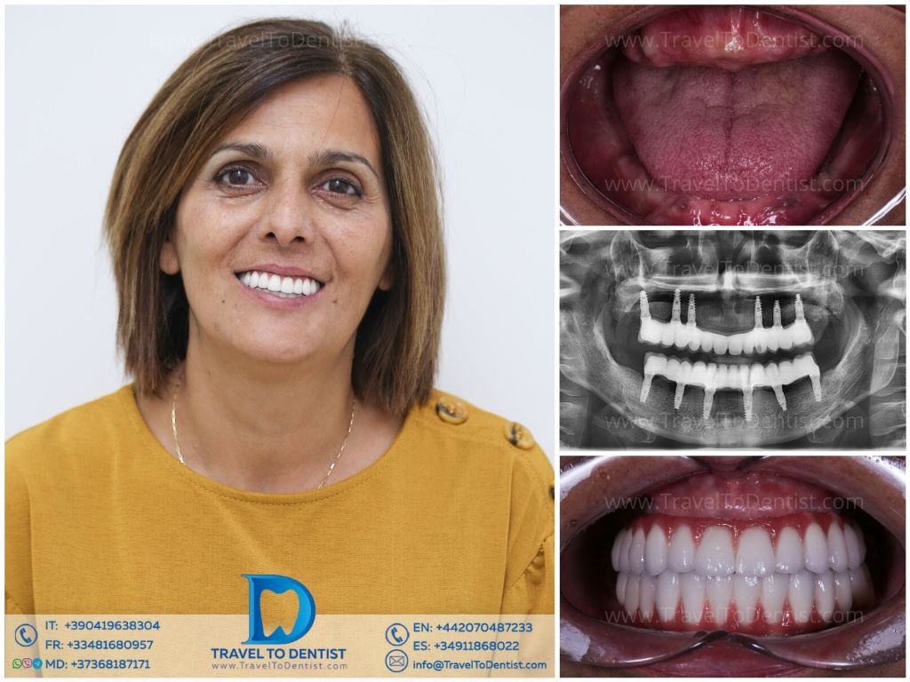 Caso dental - Resultado de tratamiento 5