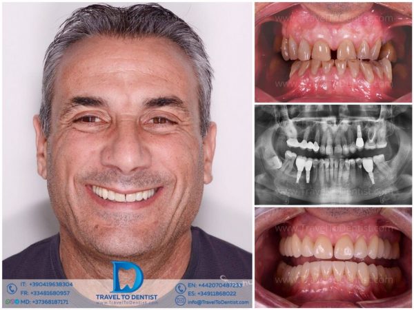 Caso dental - Resultado de tratamiento 2
