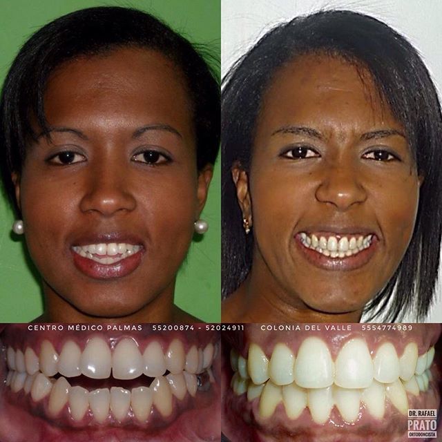 Caso dental - Resultado de tratamiento 4